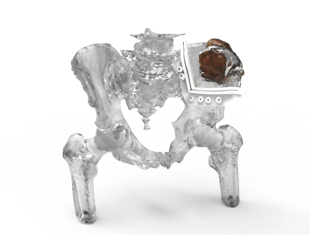 美国3D打印制造商3D Systems获FDA 510(k)许可，扩展其VSP Orthopedics虚拟手术规划与患者专用器械平台的适用范围。获批范围现涵盖骨骼结构正常的骨骼成熟青少年及成年患者。此次变更取消了先前限制青少年病例使用的监管约束，正式将这些手术纳入平台标定适应症。