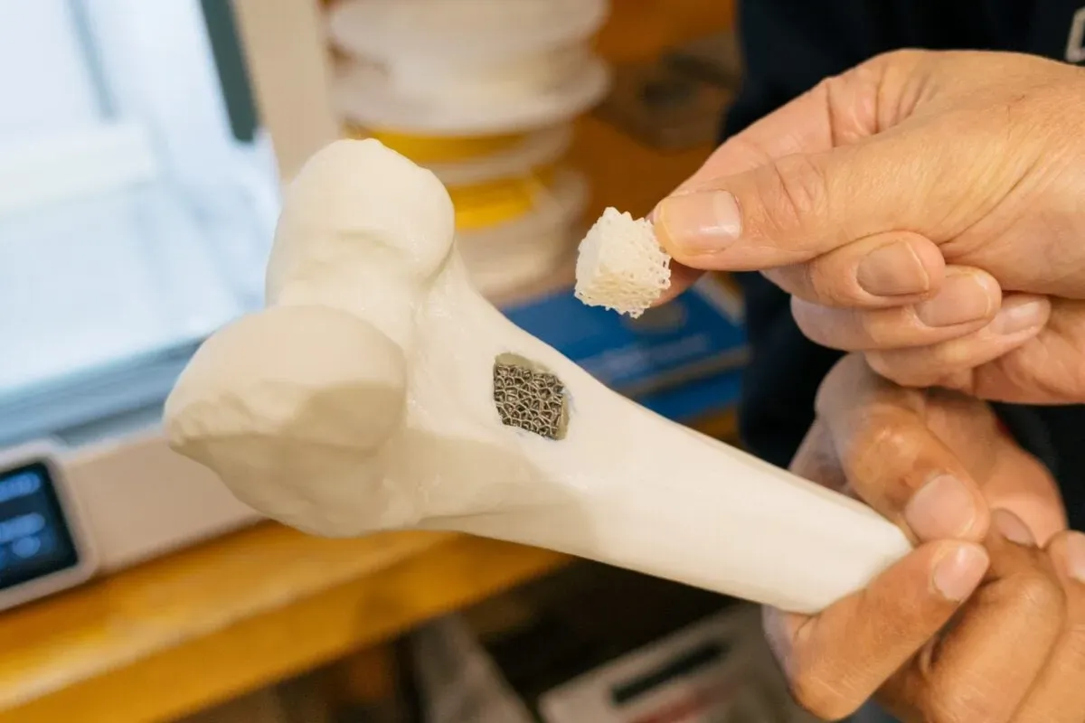 澳大利亚国防大学堪培拉校区研究人员正推进可生物降解的3D打印骨骼支架的开发，其设计可模拟天然骨骼的力学与结构特性。通过聚乳酸材料打印的随机晶格结构，该支架复现了骨骼的梯度孔隙率与强度特征，在动态载荷下展现出更强的抗冲击性与可控断裂行为。初步测试还证实其优化了营养物质输送的流体流动性——这对组织再生至关重要。尽管尚未进入临床审批阶段，本研究凸显了定制化骨修复解决方案的潜力，并强调了在医疗增材制造中架构设计与材料选择并重的重要性。