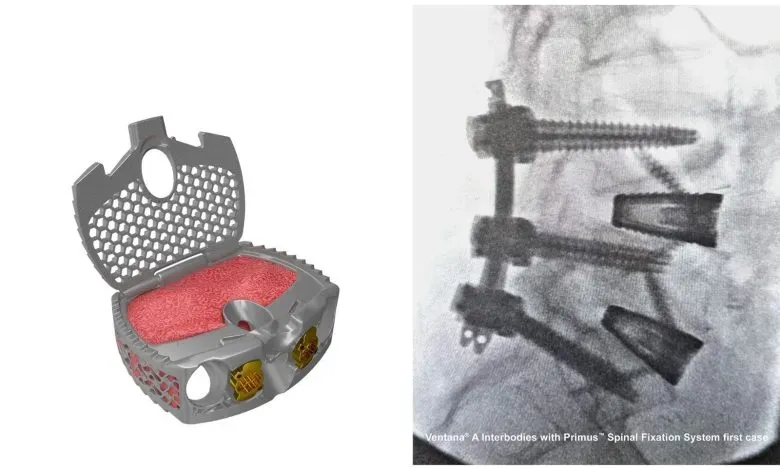 美国Spinal Elements公司通过FDA 510(k)审批，推出采用3D打印钛合金技术的Ventana A椎间融合系统。该系统通过铰链式设计与多孔结构，优化了植骨空间与力学性能，提升术中可视化及融合效果，已完成首批临床病例并获医生积极反馈。