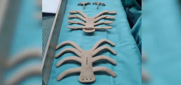 以色列医疗机构外科医生使用定制PEKK植入物，重建因罕见肉瘤切除的胸骨和肋骨